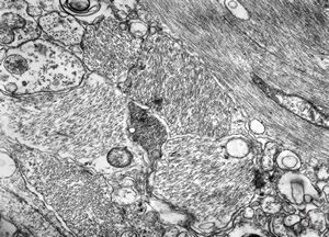 M,12y. | fibrillary astrocytoma M,12y. | fibrillary astrocytoma